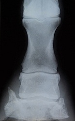 Sidebone XRay