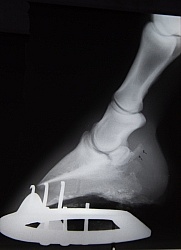 Navicular Xray Navicular Xray