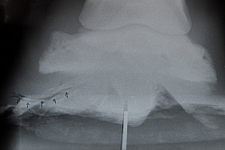 X-ray of Foot abscess Foot Abscess Xrays