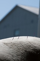 Acupuncture