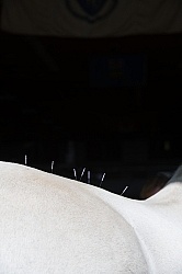 Acupuncture
