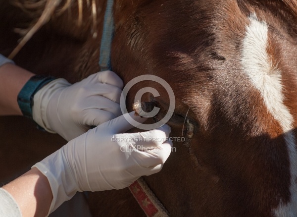 Removal of Stick From Eye