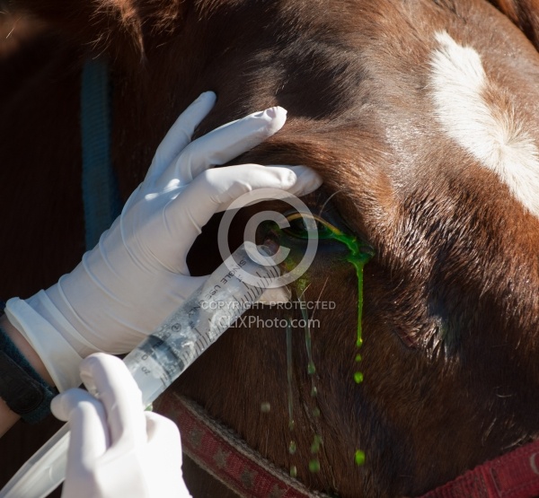 Removal of Stick From Eye