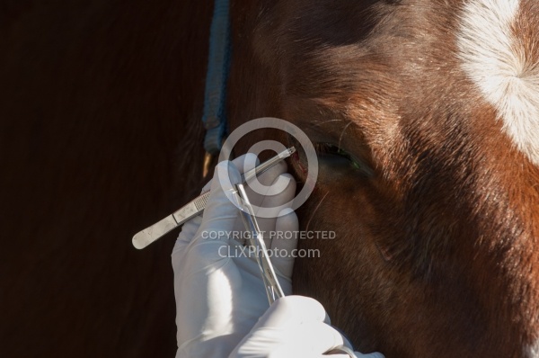 Removal of Stick From Eye