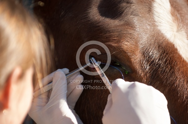 Removal of Stick From Eye