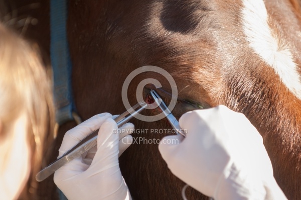 Removal of Stick From Eye