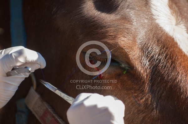 Removal of Stick From Eye