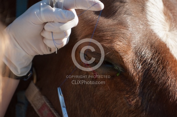 Removal of Stick From Eye
