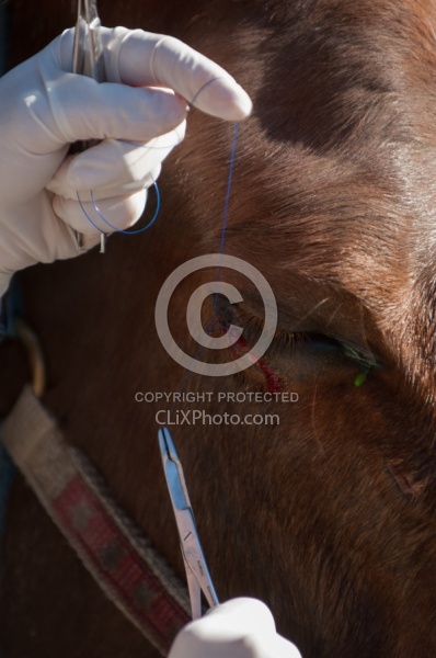 Removal of Stick From Eye