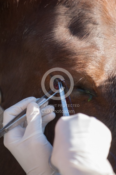 Removal of Stick From Eye